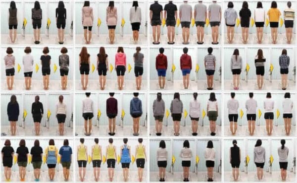 たくさんのO脚矯正実績