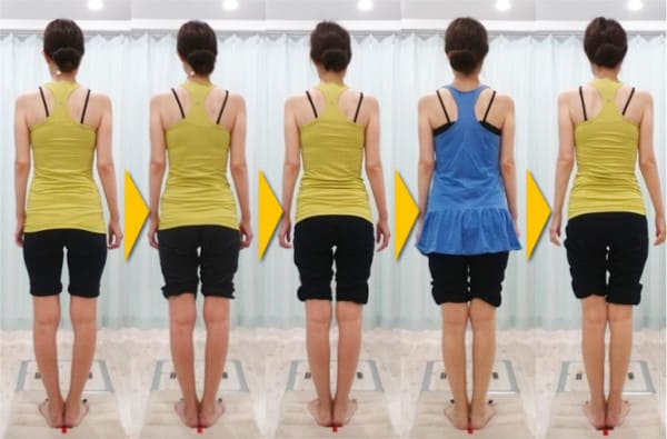 膝下内側の歪みを伴うO脚