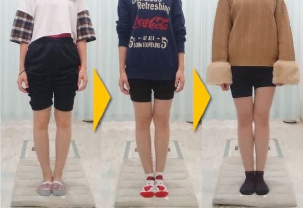 左右で歪みが異なるO脚