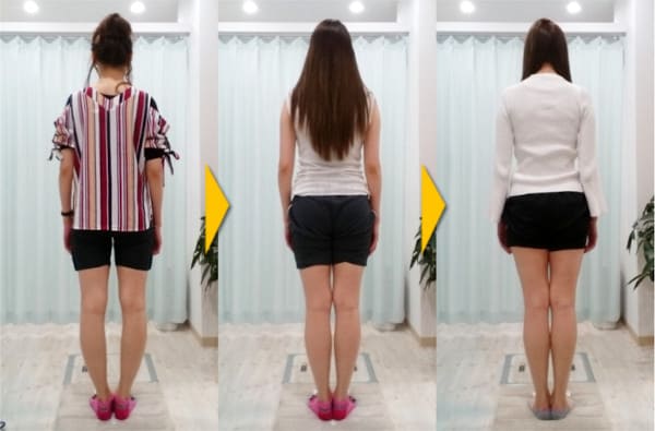 O脚矯正ビフォーアフター